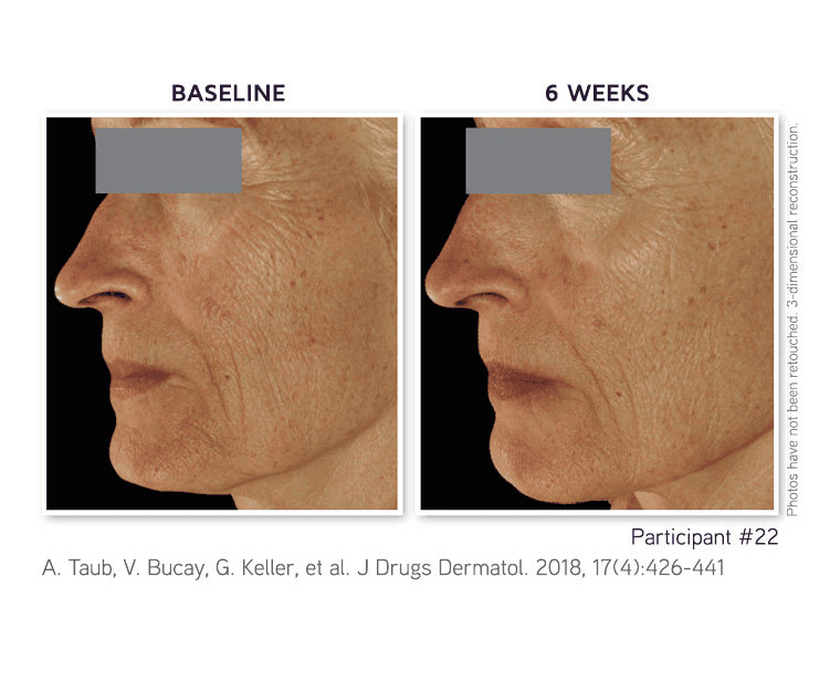 Patient 22 — Before and after DefenAge 2018 JDD study
