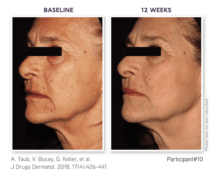Patient 10 — Before and after DefenAge 2018 JDD study
