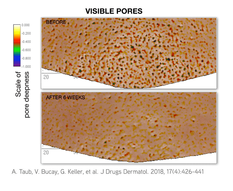 Pore reduction — DefenAge clinical study